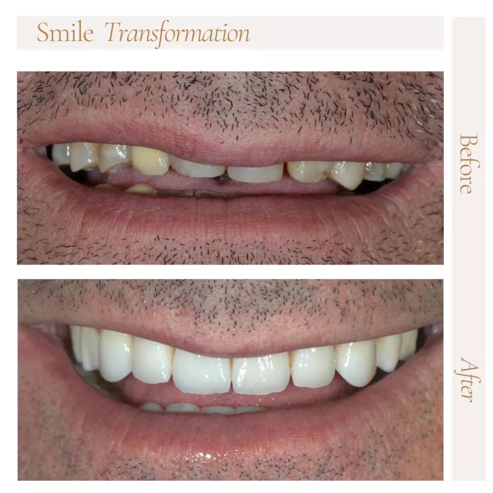 blanchiment des dents Uccle