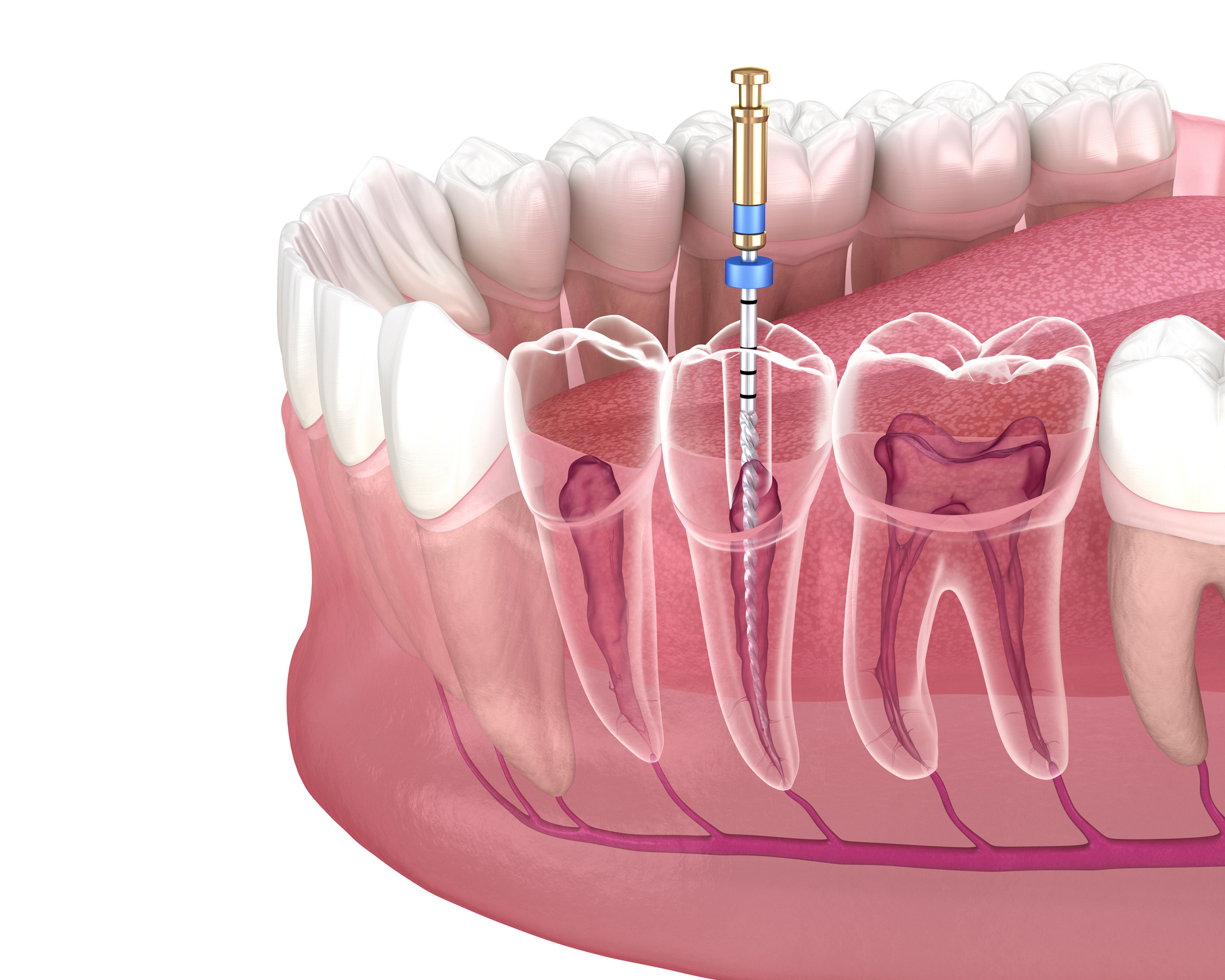 endodontie Uccle